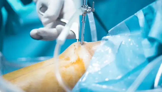 What is Arthroscopic Surgery